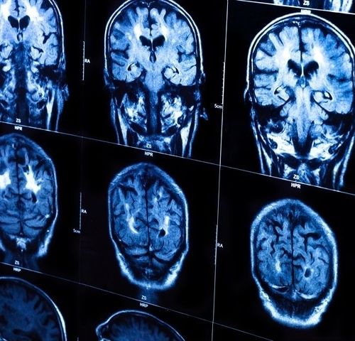 Study links kynurenine pathway to adolescent depression